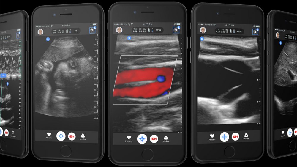 iPhone ile çalışan ultrason cihazı