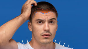 Saç dökülmesini fotoğraflar üzerinden analiz ederek öneriler sunan yapay zeka servisi: "MyHair AI"